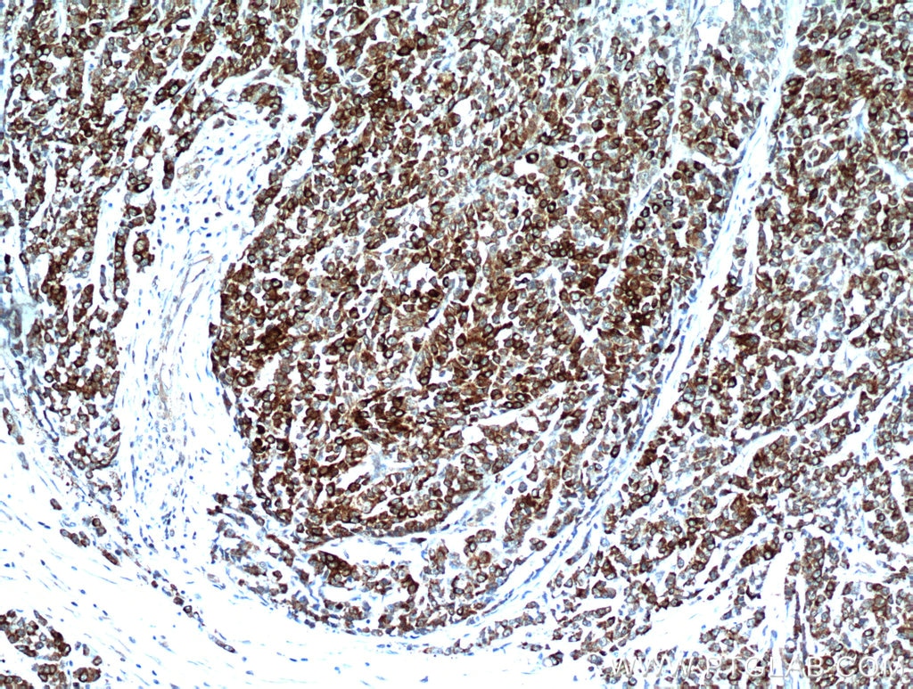 IHC staining of human colon cancer using 21206-1-AP