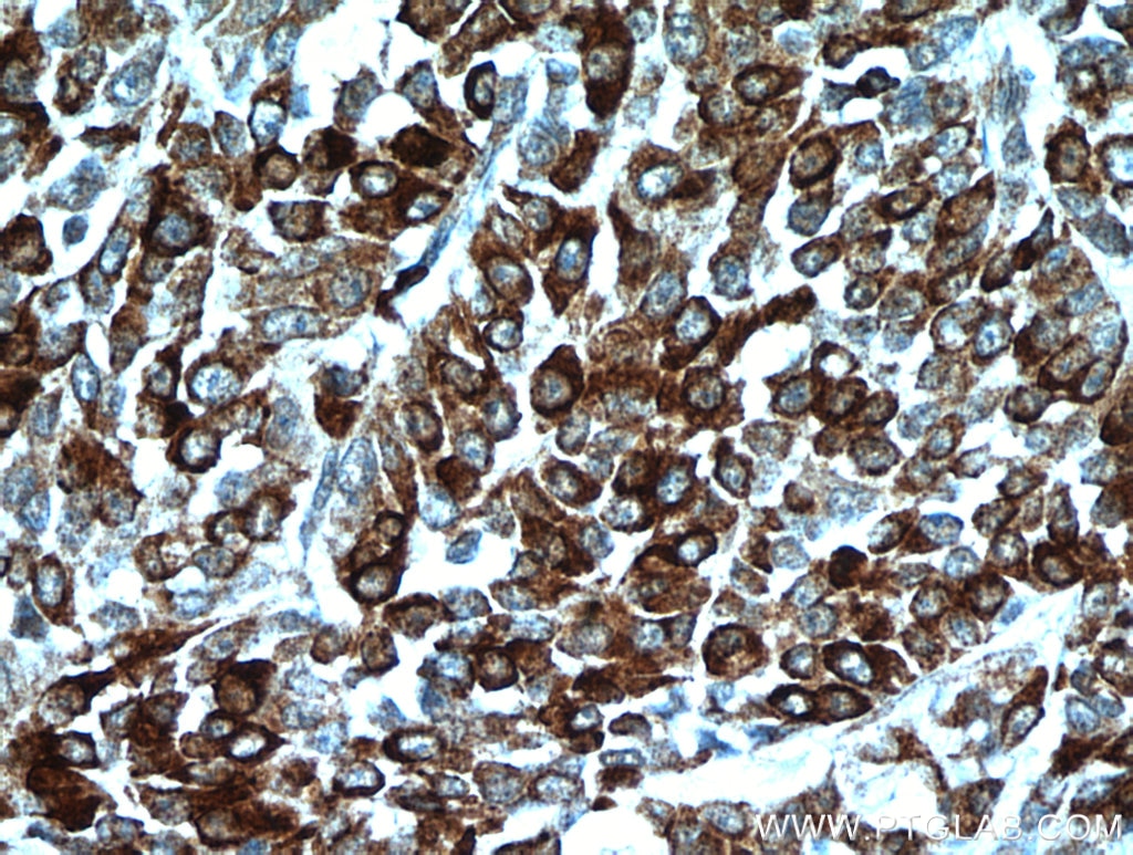 IHC staining of human colon cancer using 21206-1-AP