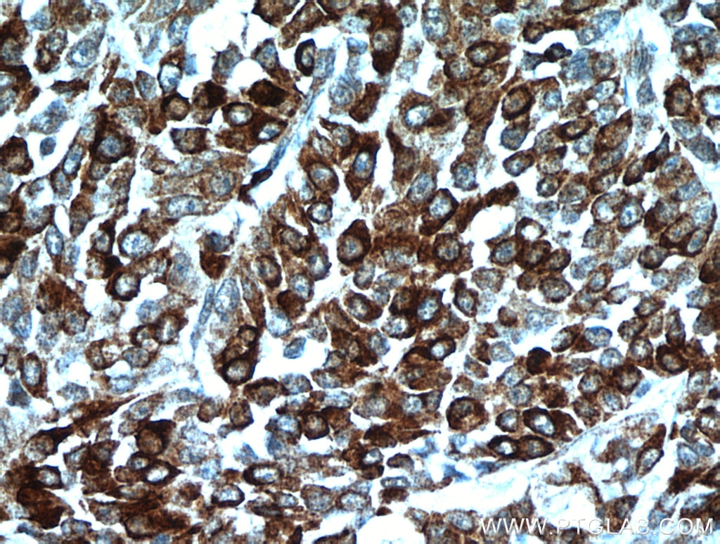 Immunohistochemistry (IHC) staining of human colon cancer tissue using HSPA4 Polyclonal antibody (21206-1-AP)