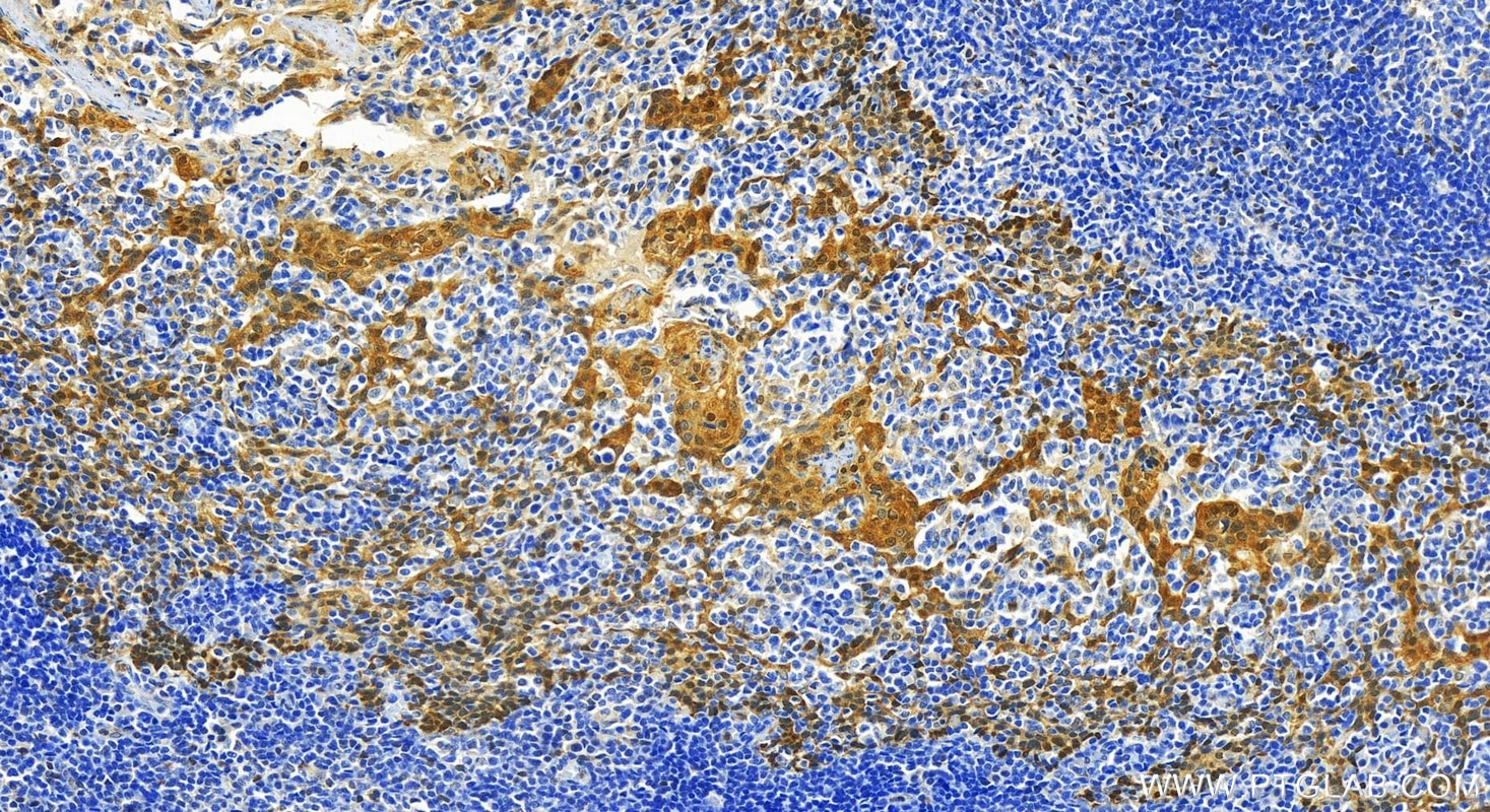 Immunohistochemistry (IHC) staining of human tonsillitis tissue using HSPA1B Polyclonal antibody (25405-1-AP)