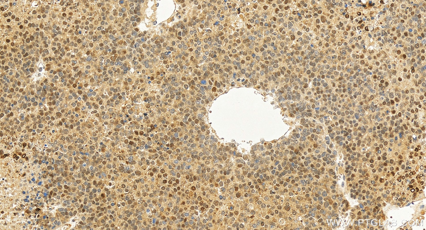 Immunohistochemical analysis of paraffin-embedded human hepatocellular carcinoma slide using 66183-1-Ig (HSP70 antibody) at dilution of 1:800 (under 20x lens). Heat mediated antigen retrieval with Tris-EDTA buffer (pH 9.0). Immunohistochemistry (IHC) staining of human hepatocellular carcinoma using HSP70 Monoclonal antibody (66183-1-Ig)