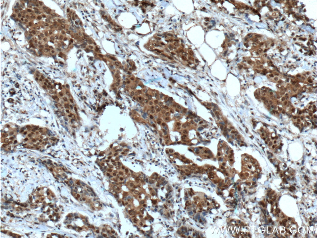 Immunohistochemistry (IHC) staining of human breast cancer tissue using HSP70 Monoclonal antibody (66183-1-Ig)