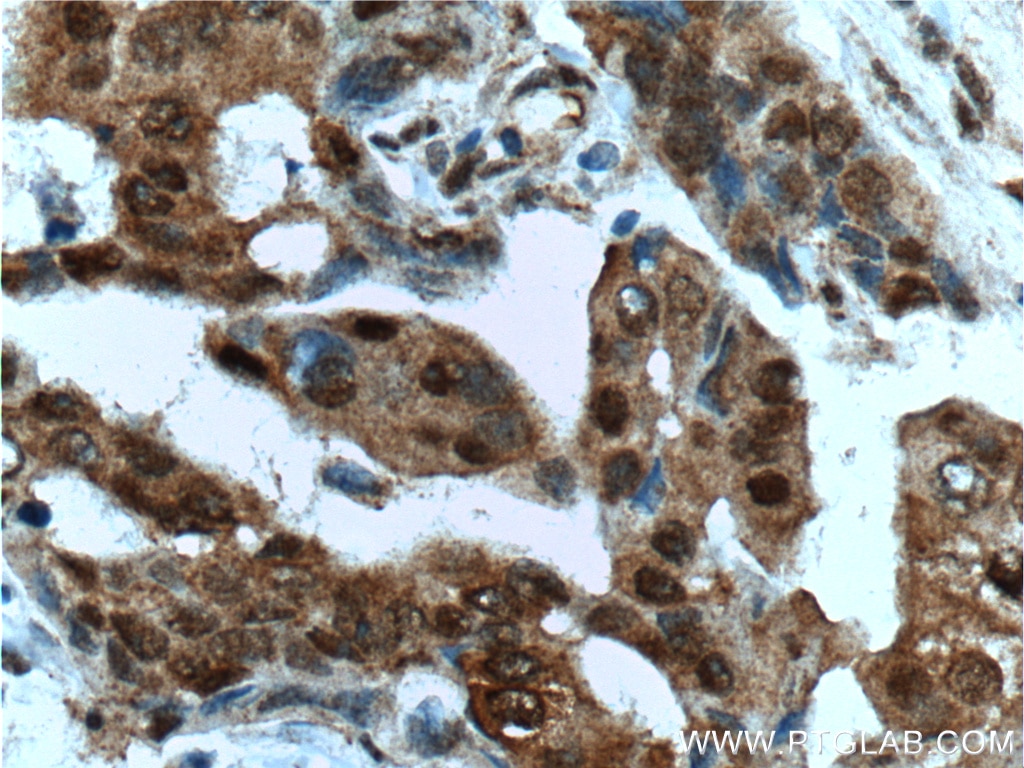 Immunohistochemistry (IHC) staining of human breast cancer tissue using HSP70 Monoclonal antibody (66183-1-Ig)