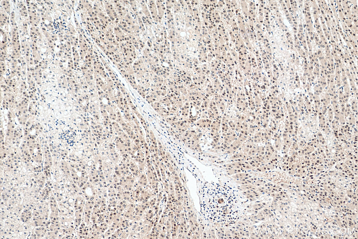 Immunohistochemistry (IHC) staining of human liver cancer tissue using HSP70 Recombinant antibody (80735-1-RR)
