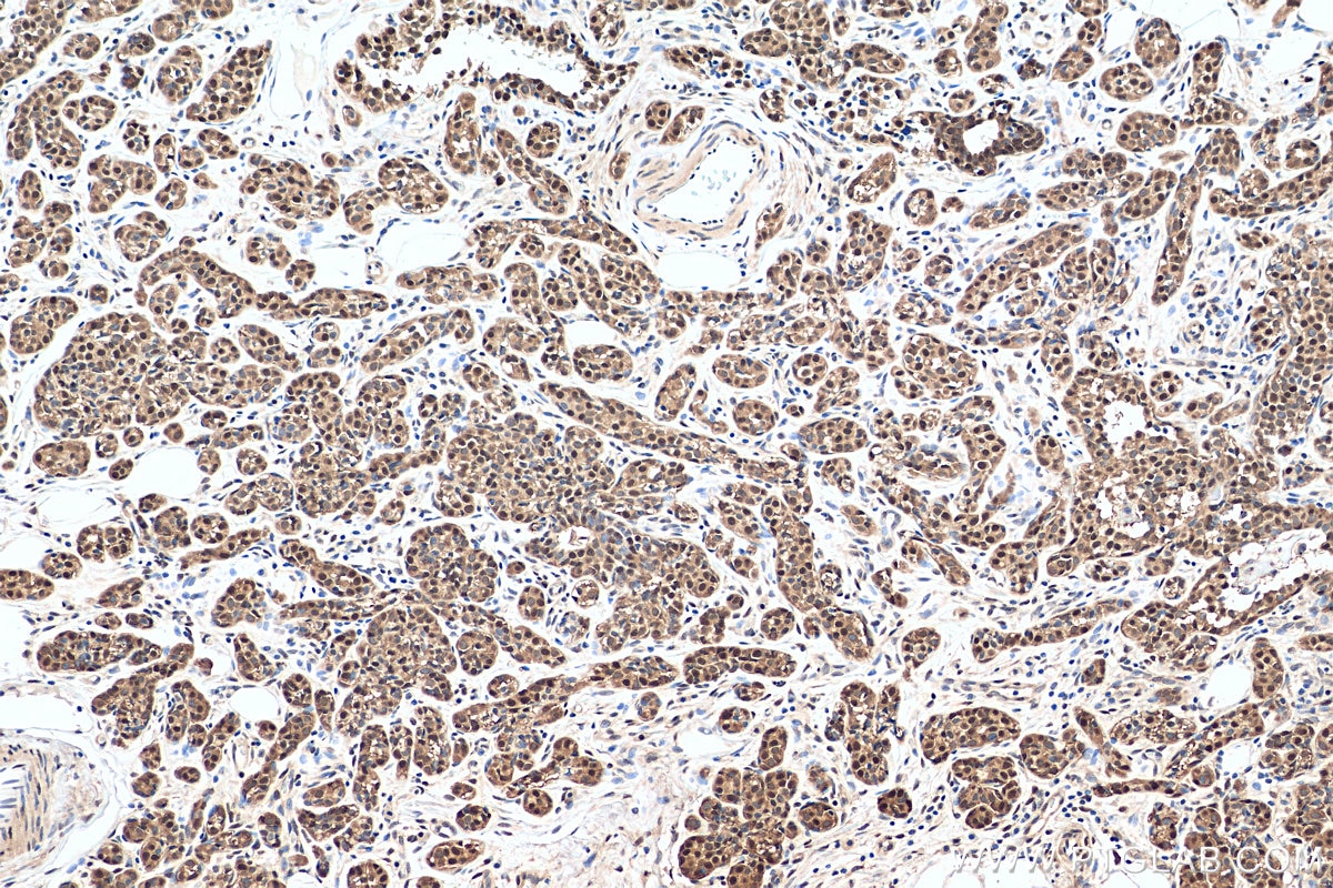 Immunohistochemistry (IHC) staining of human breast cancer tissue using HSP70 Recombinant antibody (80735-1-RR)