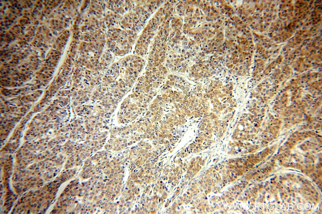 Immunohistochemistry (IHC) staining of human liver cancer tissue using HSP90 Polyclonal antibody (13171-1-AP)