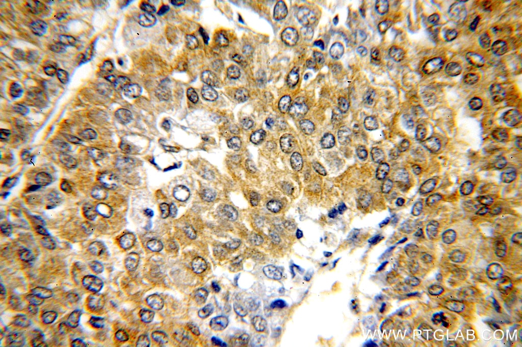 Immunohistochemistry (IHC) staining of human liver cancer tissue using HSP90 Polyclonal antibody (13171-1-AP)