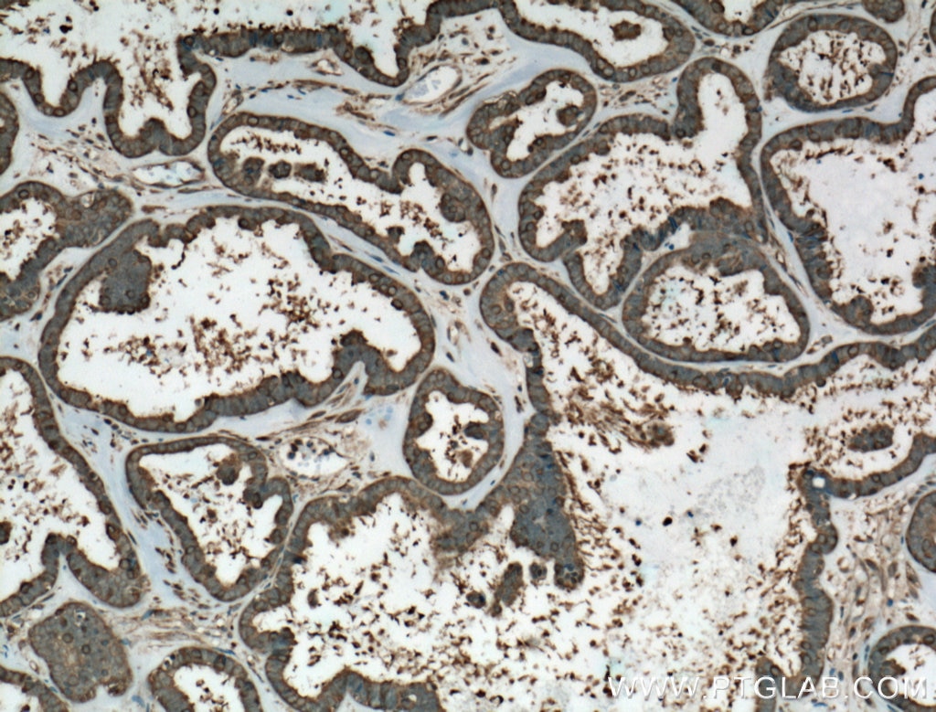 Immunohistochemistry (IHC) staining of human ovary tumor tissue using HSP90 Monoclonal antibody (60318-1-Ig)