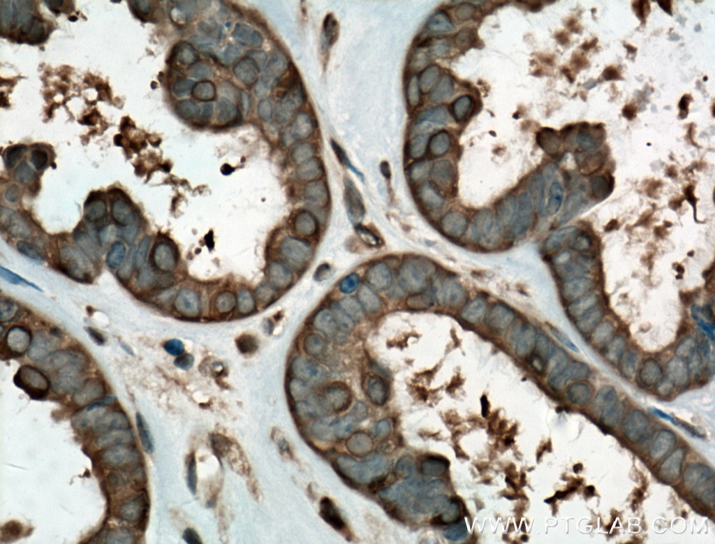 Immunohistochemistry (IHC) staining of human ovary tumor tissue using HSP90 Monoclonal antibody (60318-1-Ig)