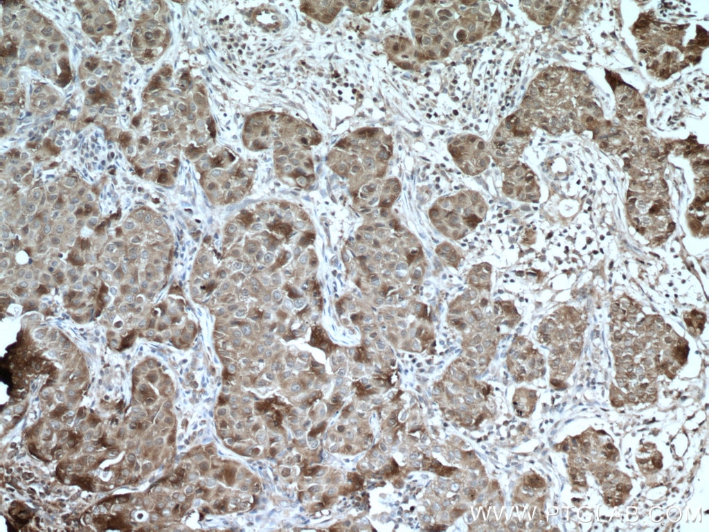 Immunohistochemistry (IHC) staining of human breast cancer tissue using HSP90AB1 Polyclonal antibody (11405-1-AP)