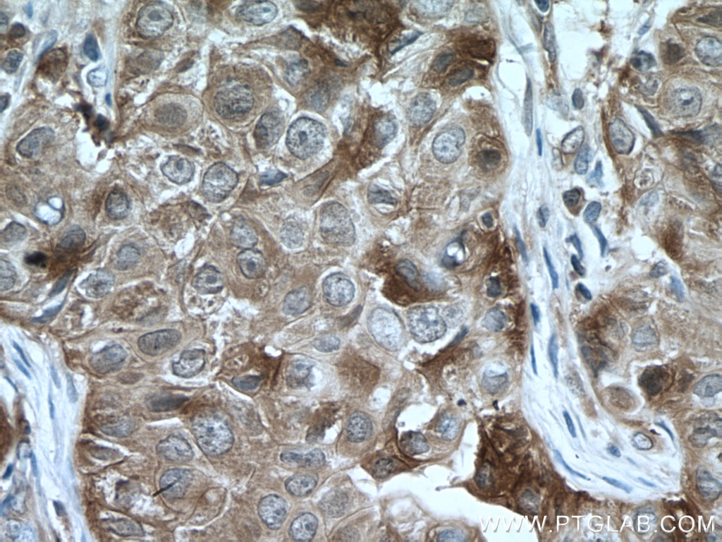Immunohistochemistry (IHC) staining of human breast cancer tissue using HSP90AB1 Polyclonal antibody (11405-1-AP)