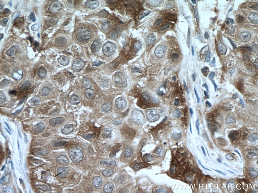 IHC staining of human breast cancer using 11405-1-AP