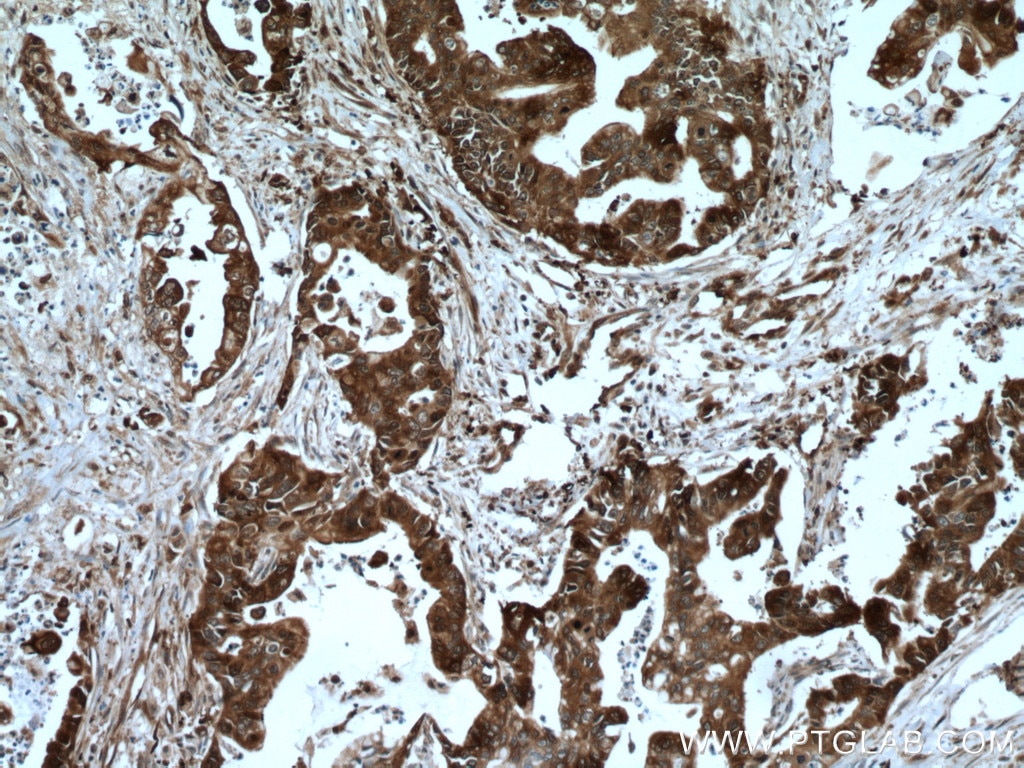 Immunohistochemistry (IHC) staining of human pancreas cancer tissue using HSP90AB1 Polyclonal antibody (11405-1-AP)