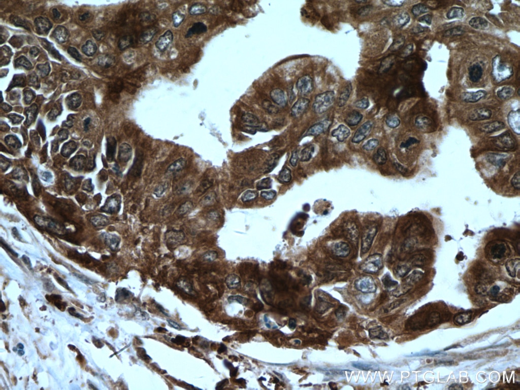 Immunohistochemistry (IHC) staining of human pancreas cancer tissue using HSP90AB1 Polyclonal antibody (11405-1-AP)