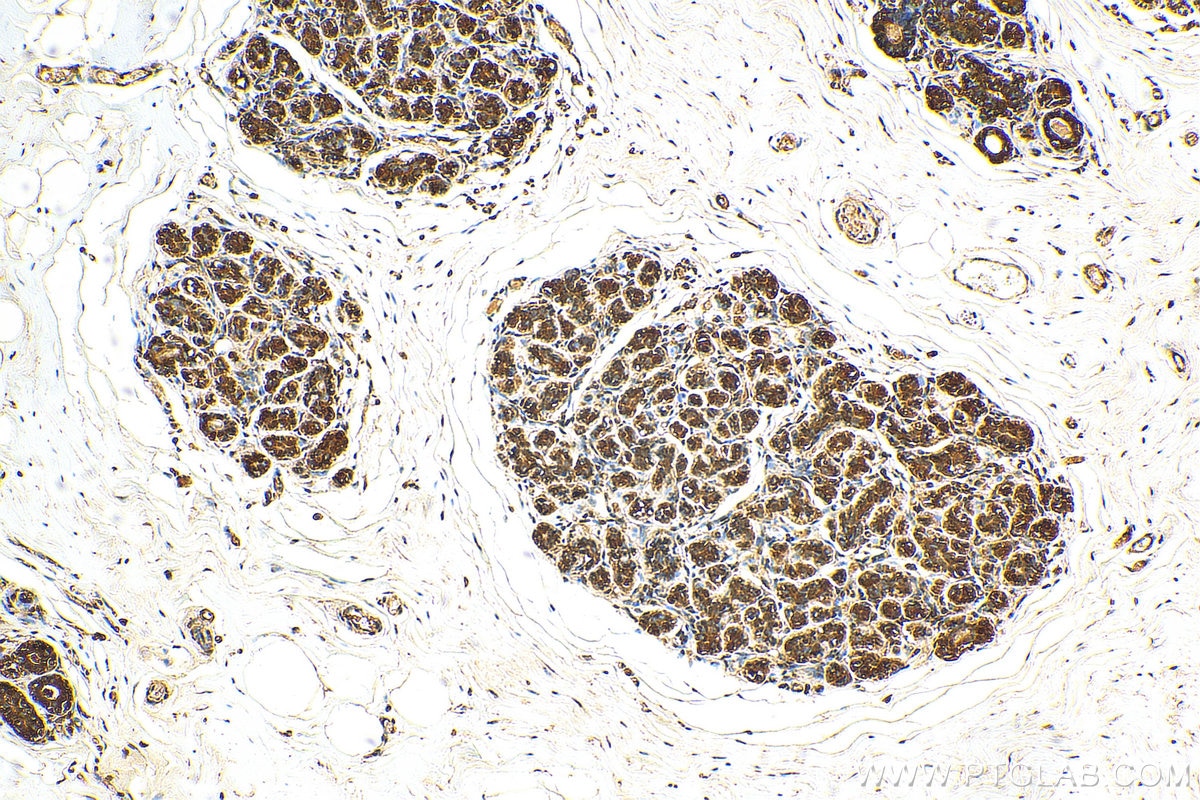 Immunohistochemistry (IHC) staining of human breast cancer tissue using HSP90AB1 Recombinant antibody (80301-1-RR)