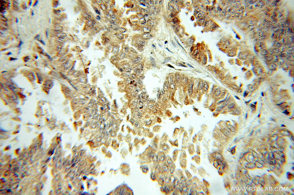 IHC staining of human lung cancer using 10979-1-AP