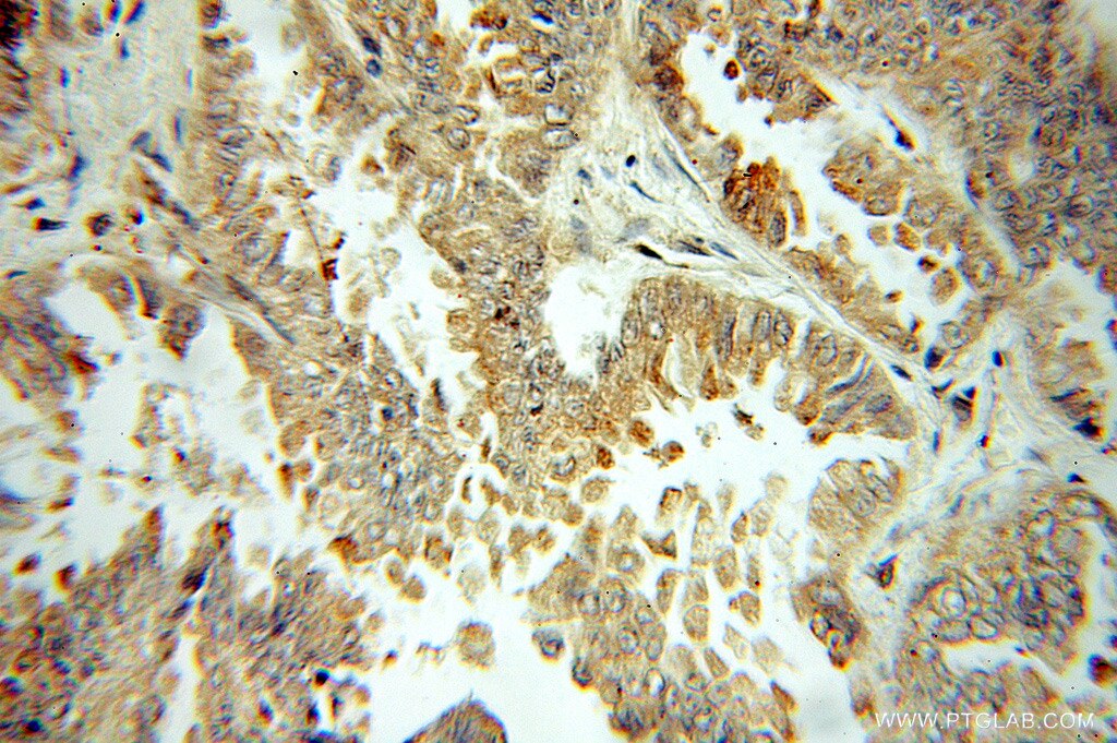 Immunohistochemistry (IHC) staining of human lung cancer tissue using GRP94 Polyclonal antibody (10979-1-AP)