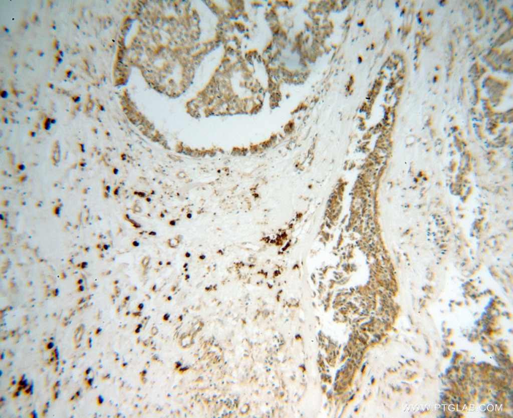 Immunohistochemistry (IHC) staining of human breast cancer tissue using GRP94 Polyclonal antibody (10979-1-AP)