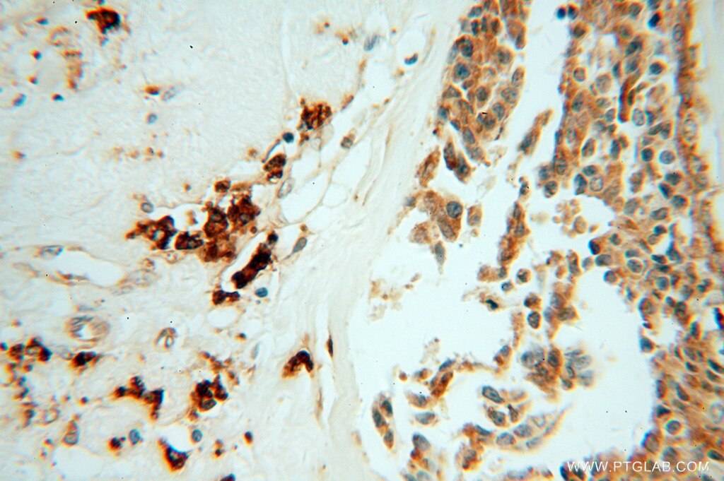 Immunohistochemistry (IHC) staining of human breast cancer tissue using GRP94 Polyclonal antibody (10979-1-AP)