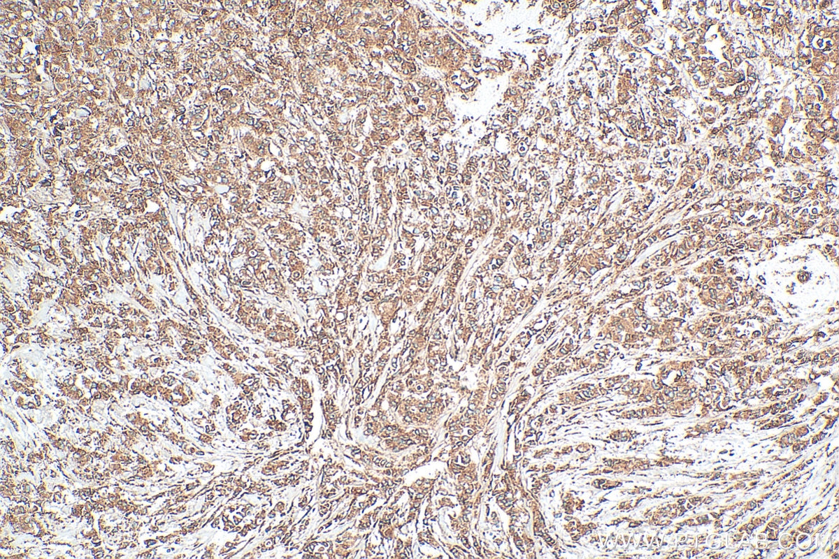 Immunohistochemistry (IHC) staining of human breast cancer tissue using GRP94 Polyclonal antibody (14700-1-AP)