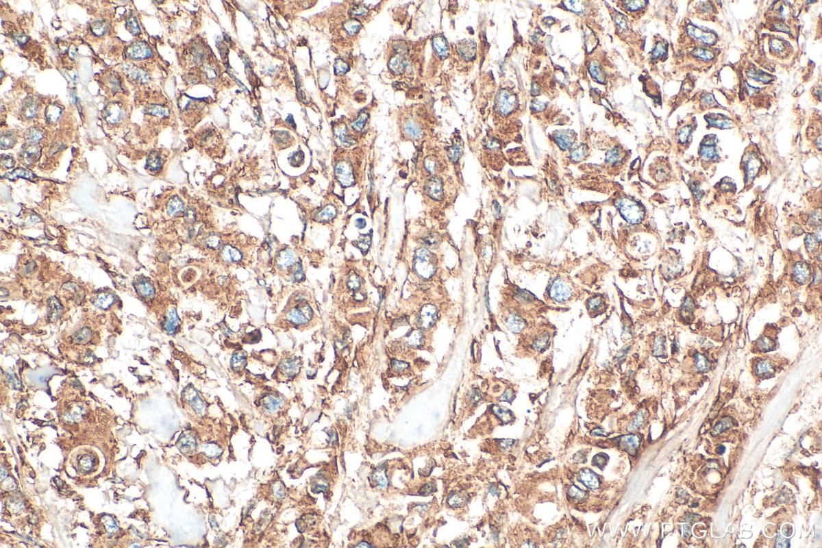 Immunohistochemistry (IHC) staining of human breast cancer tissue using GRP94 Polyclonal antibody (14700-1-AP)