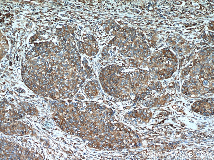 Immunohistochemistry (IHC) staining of human cervical cancer tissue using GRP94 Polyclonal antibody (14700-1-AP)