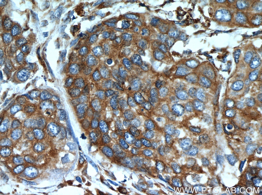 Immunohistochemistry (IHC) staining of human cervical cancer tissue using GRP94 Polyclonal antibody (14700-1-AP)