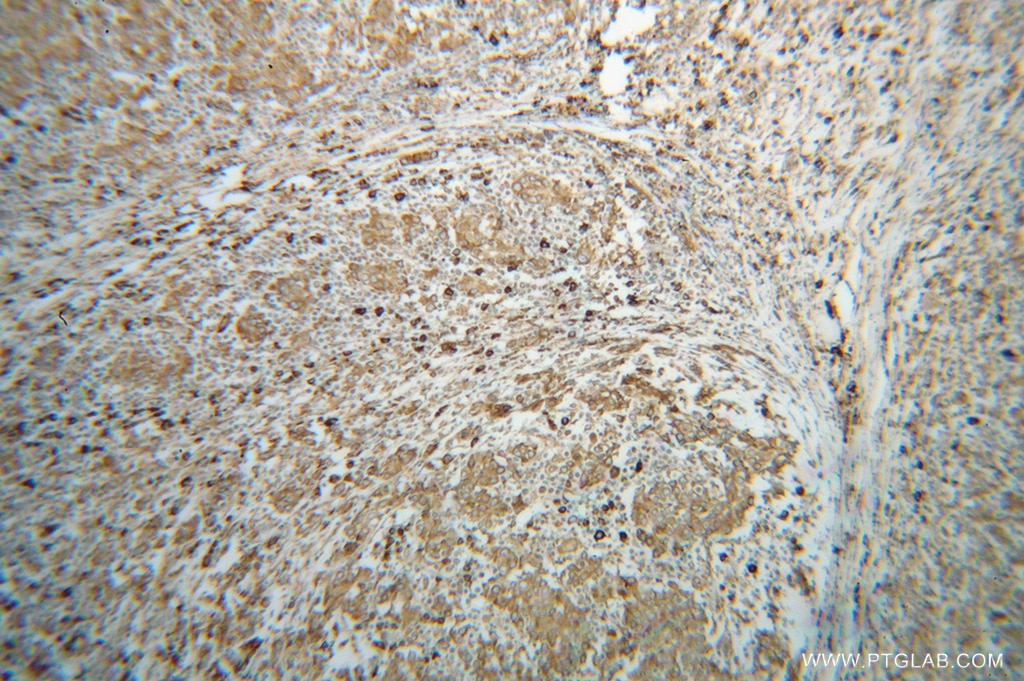 IHC staining of human breast cancer using 14700-1-AP