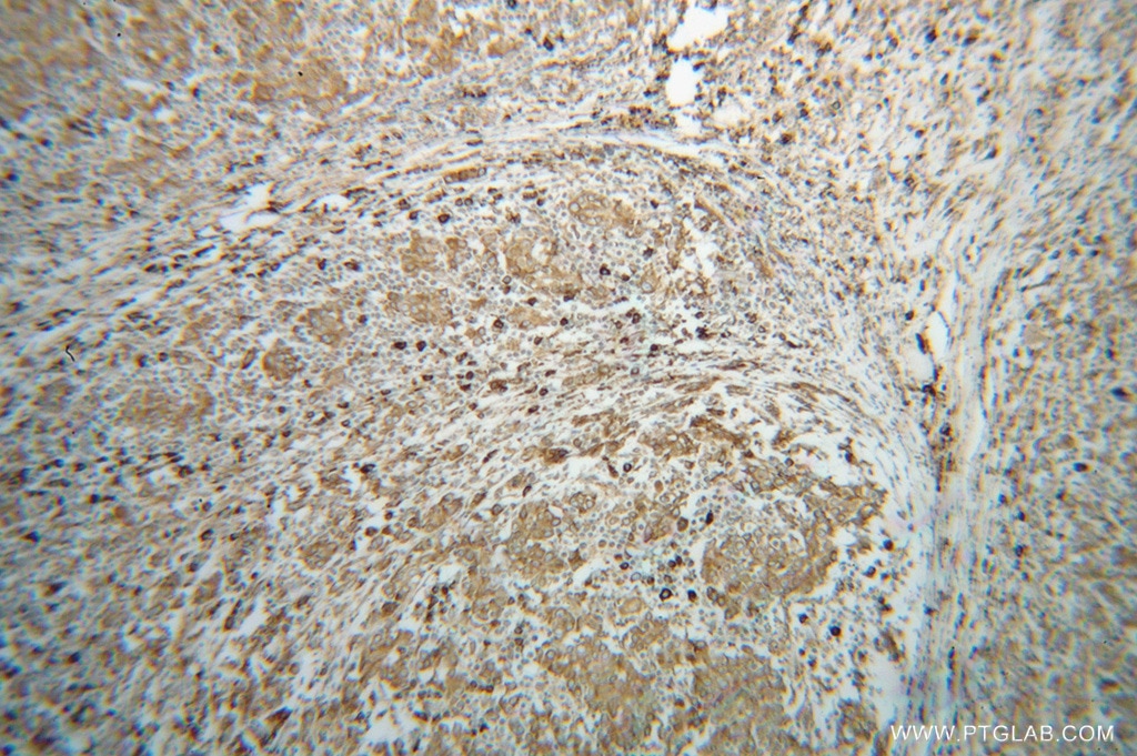 Immunohistochemistry (IHC) staining of human breast cancer tissue using GRP94 Polyclonal antibody (14700-1-AP)