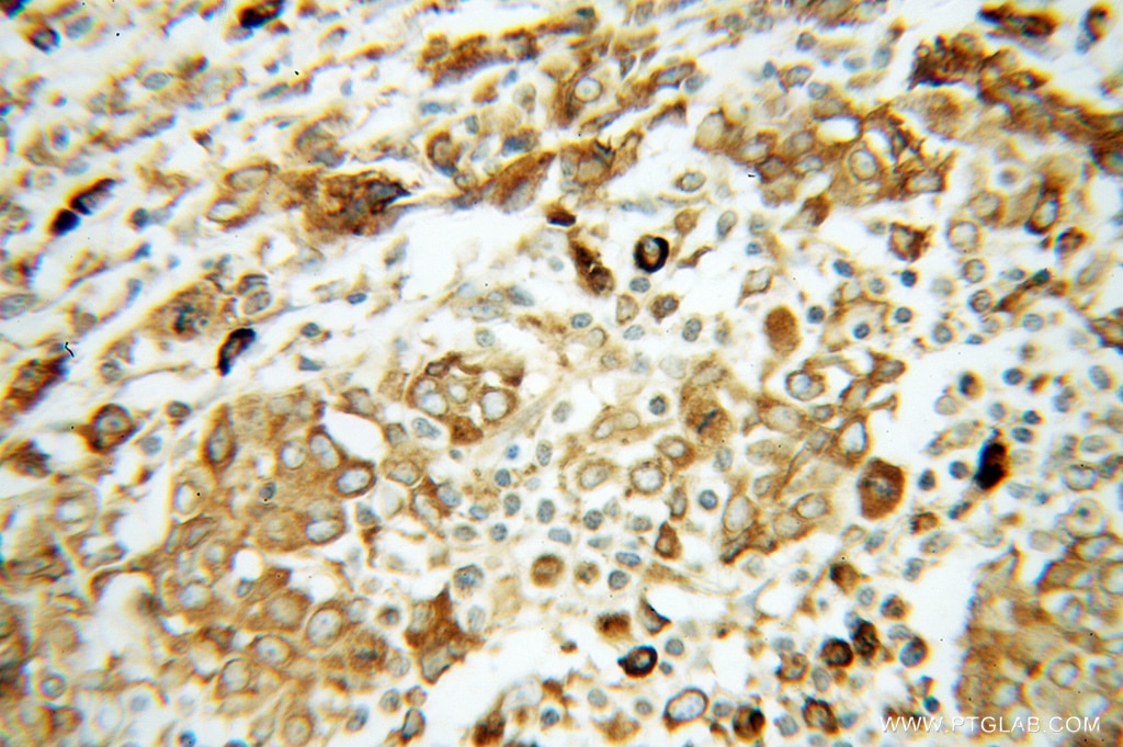 Immunohistochemistry (IHC) staining of human breast cancer tissue using GRP94 Polyclonal antibody (14700-1-AP)