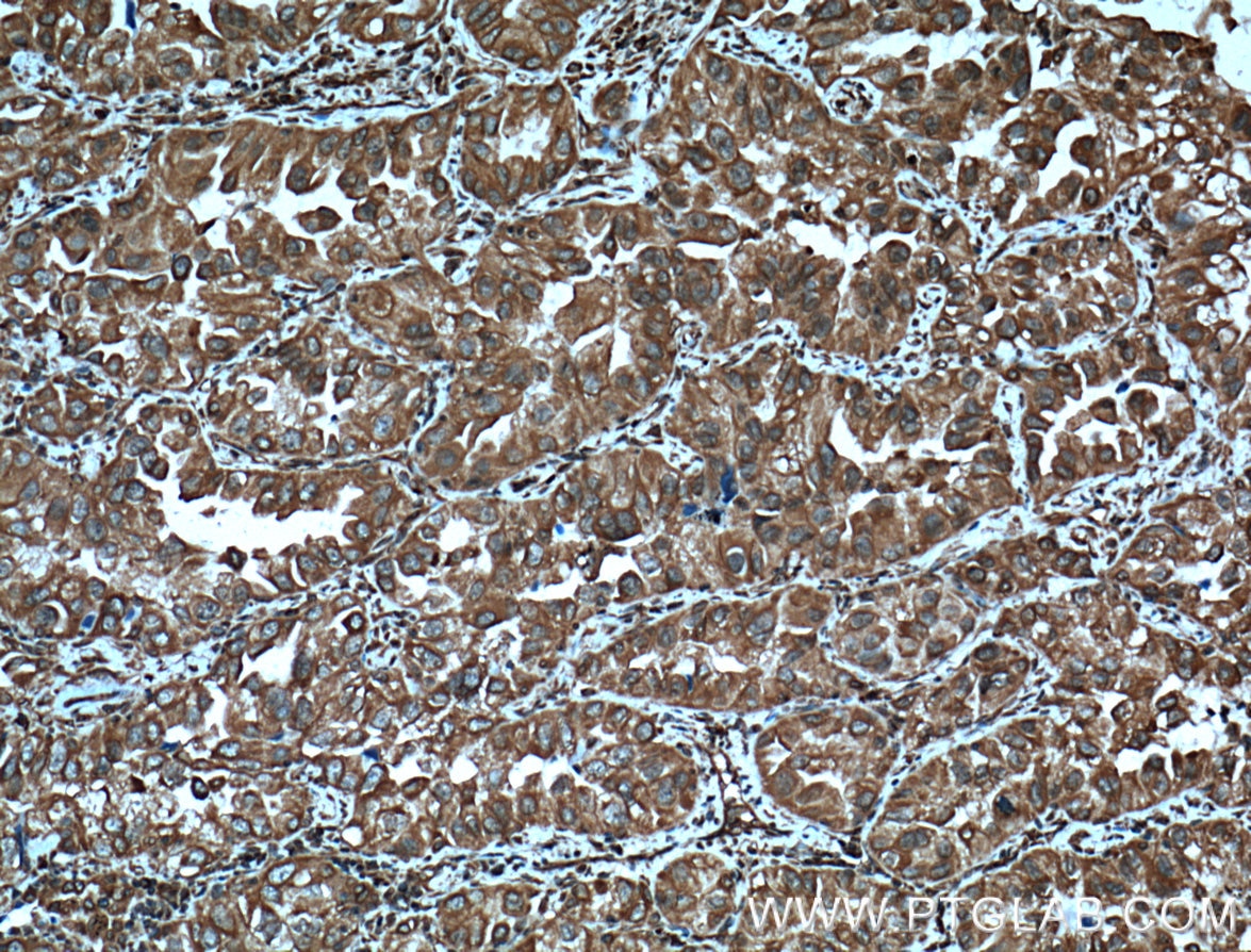 Immunohistochemistry (IHC) staining of human lung cancer tissue using GRP94 Monoclonal antibody (60012-1-Ig)