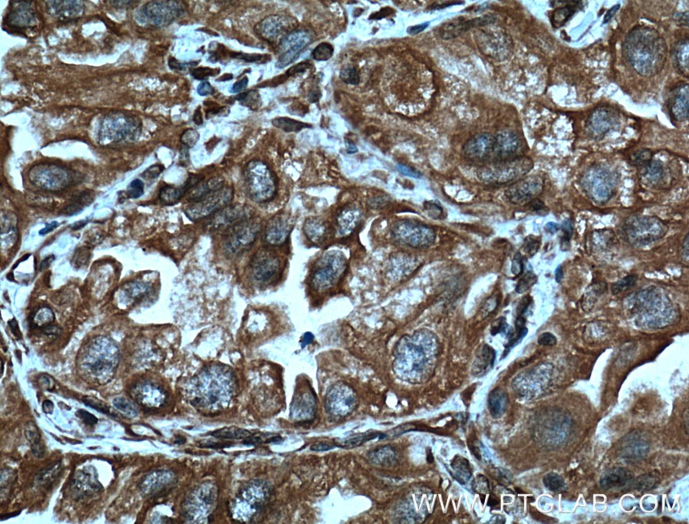 Immunohistochemistry (IHC) staining of human lung cancer tissue using GRP94 Monoclonal antibody (60012-1-Ig)