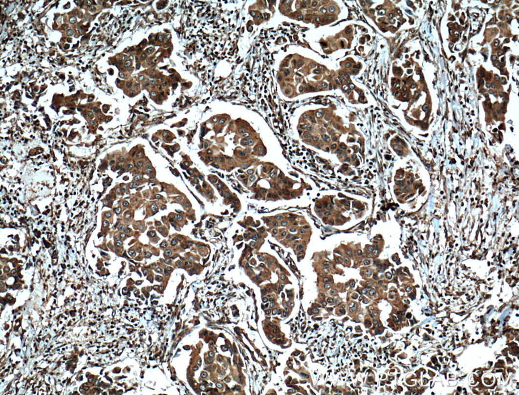 Immunohistochemistry (IHC) staining of human breast cancer tissue using GRP94 Monoclonal antibody (60012-1-Ig)