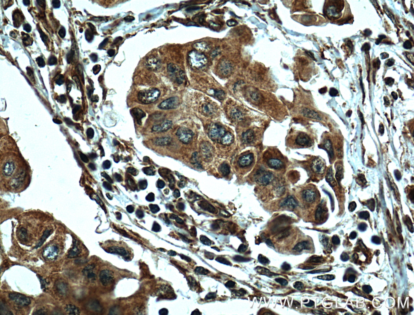 Immunohistochemistry (IHC) staining of human breast cancer tissue using GRP94 Monoclonal antibody (60012-1-Ig)