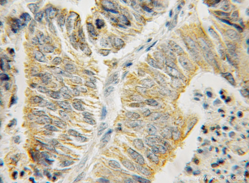 Immunohistochemistry (IHC) staining of human endometrial cancer tissue using HSPA13 Polyclonal antibody (12667-2-AP)