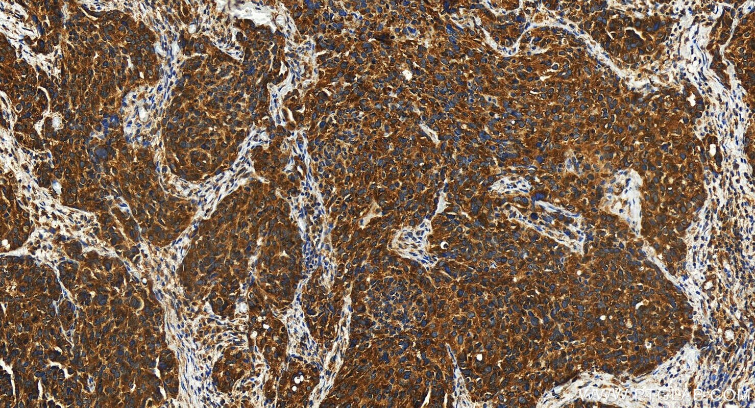 Immunohistochemistry (IHC) staining of human ovary cancer tissue using HSPA14 Polyclonal antibody (28503-1-AP)