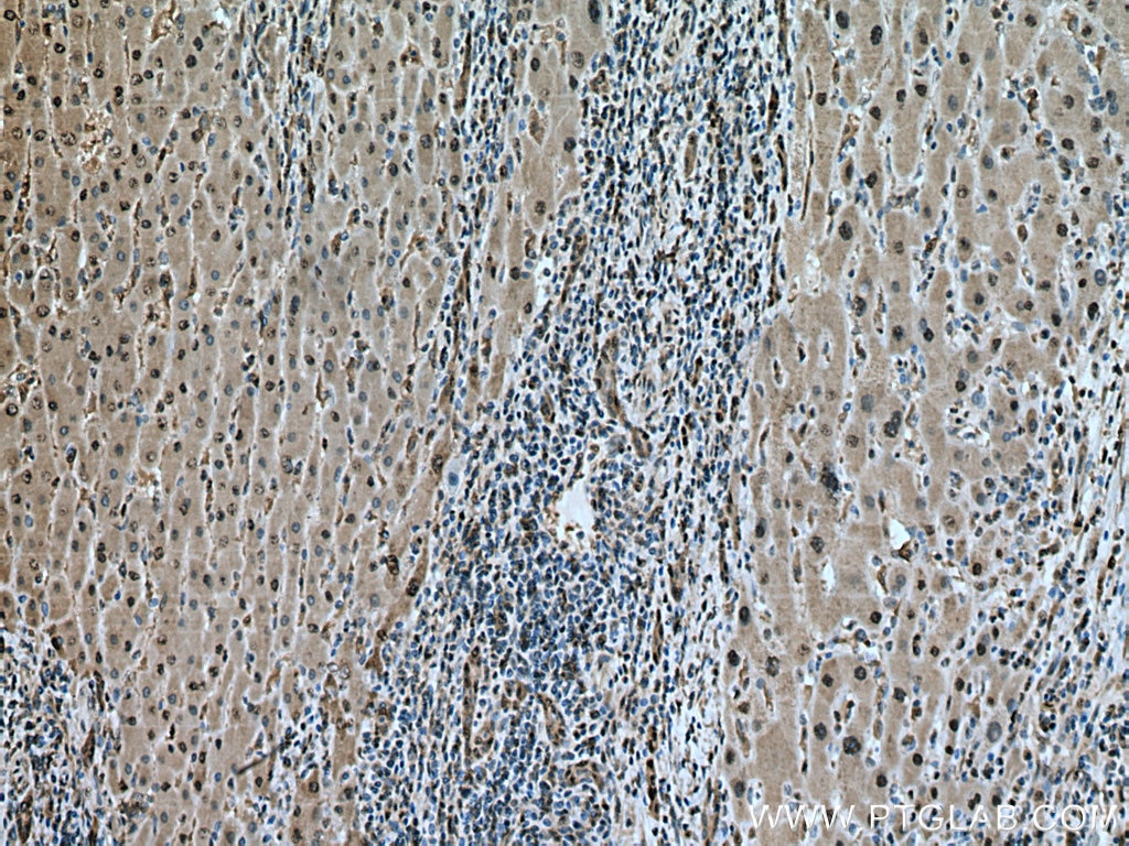 Immunohistochemistry (IHC) staining of human liver cancer tissue using HSP70 Polyclonal antibody (10995-1-AP)