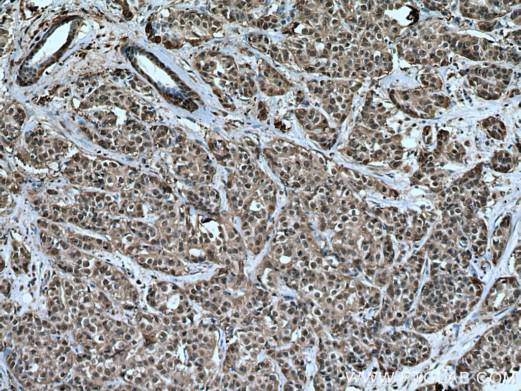 Immunohistochemistry (IHC) staining of human breast cancer tissue using HSP70 Polyclonal antibody (10995-1-AP)