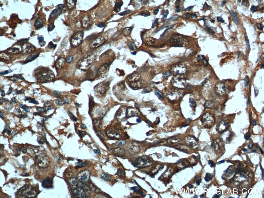 Immunohistochemistry (IHC) staining of human liver cancer tissue using HSP70 Polyclonal antibody (10995-1-AP)