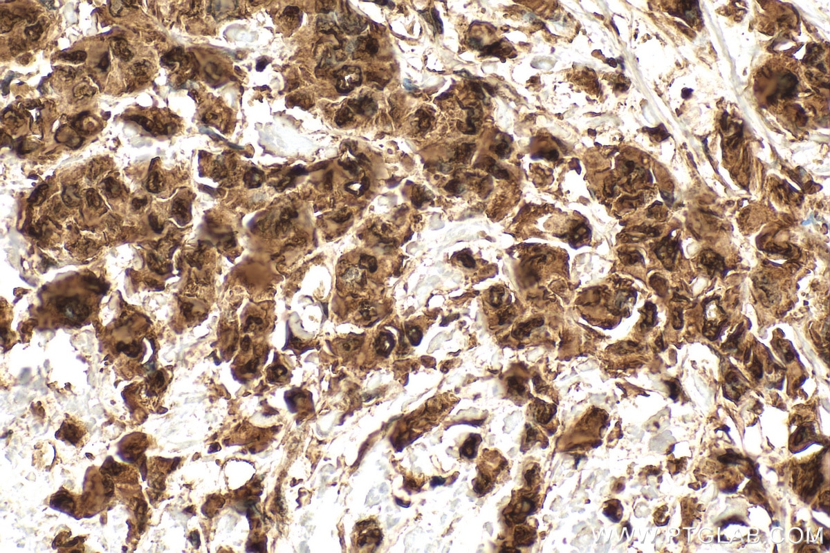 Immunohistochemistry (IHC) staining of human breast cancer tissue using HSP70 Polyclonal antibody (10995-1-AP)