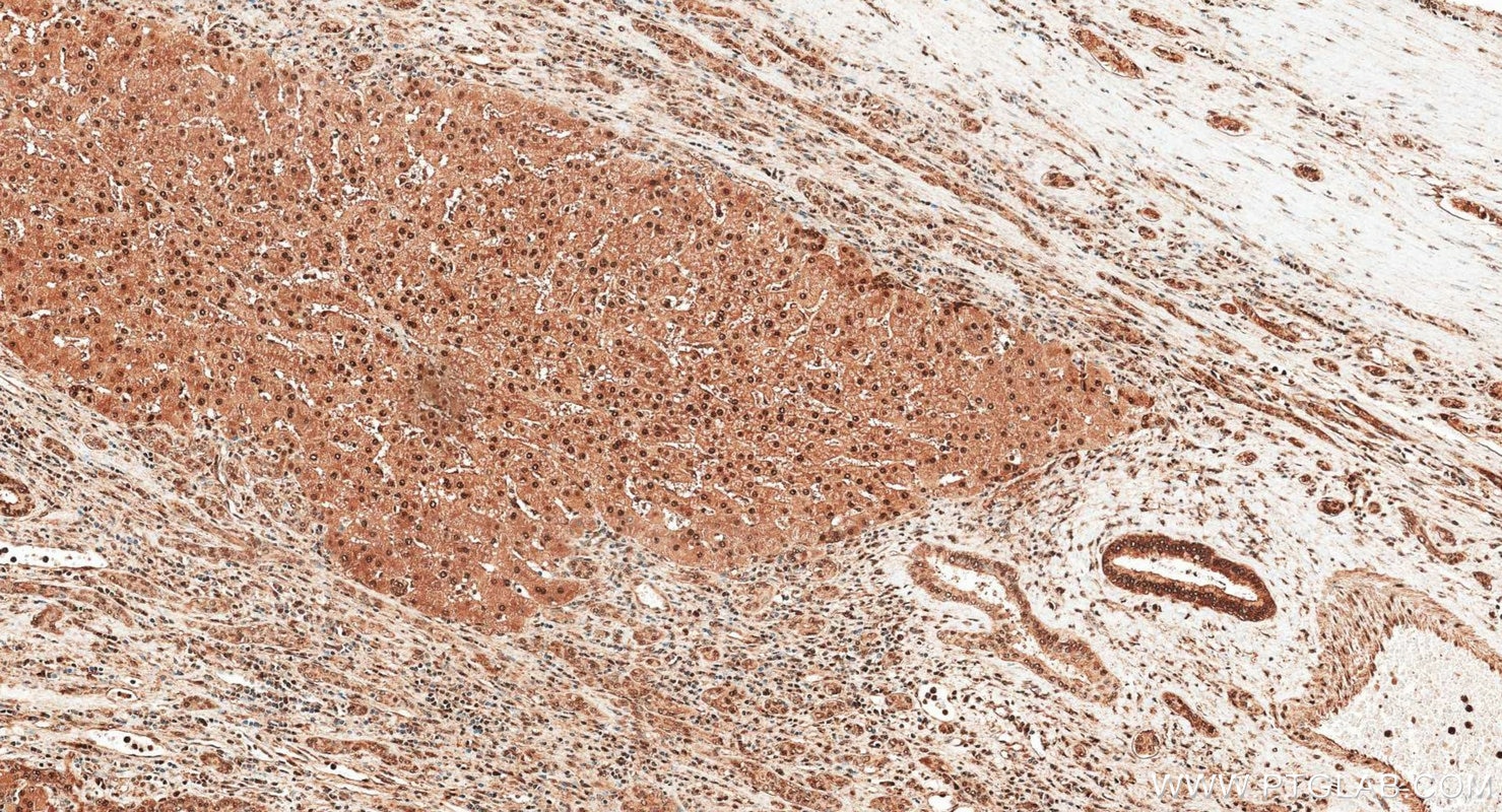 Immunohistochemistry (IHC) staining of human liver cancer tissue using HSP70 Polyclonal antibody (10995-1-AP)