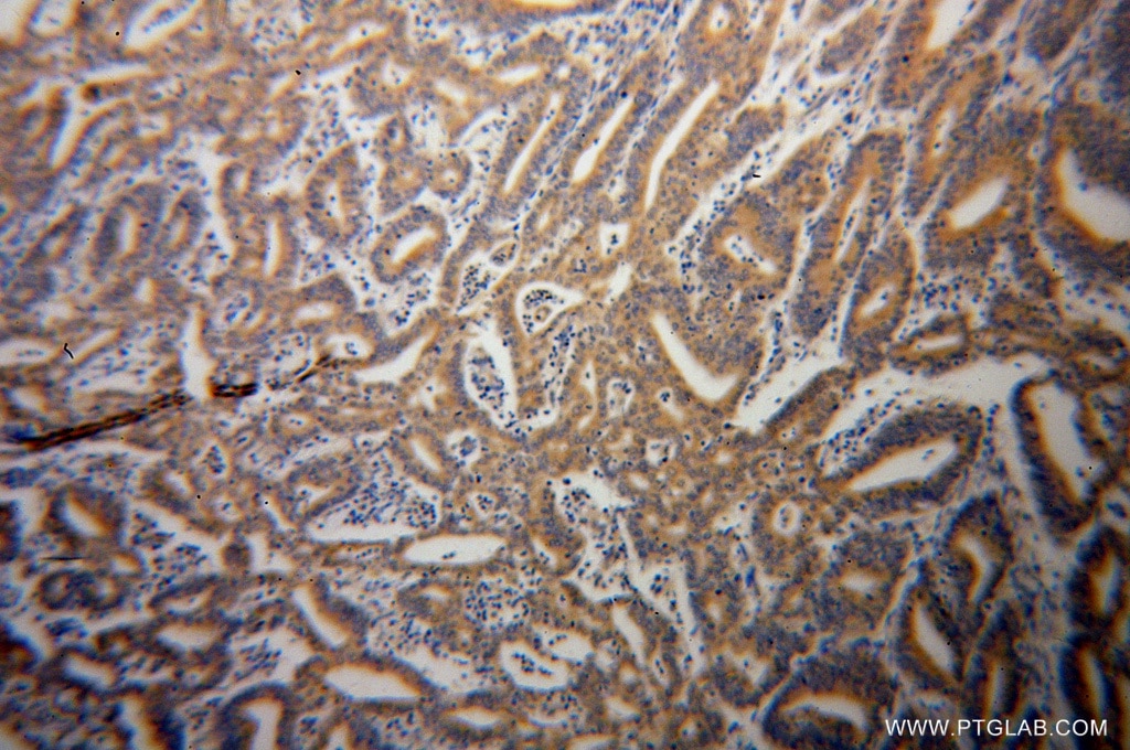 Immunohistochemistry (IHC) staining of human endometrial cancer tissue using HSPA1L Polyclonal antibody (13970-1-AP)