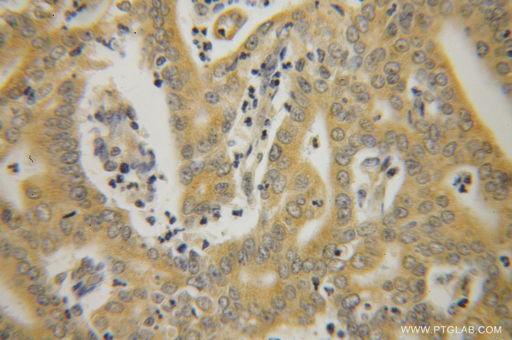Immunohistochemistry (IHC) staining of human endometrial cancer tissue using HSPA1L Polyclonal antibody (13970-1-AP)