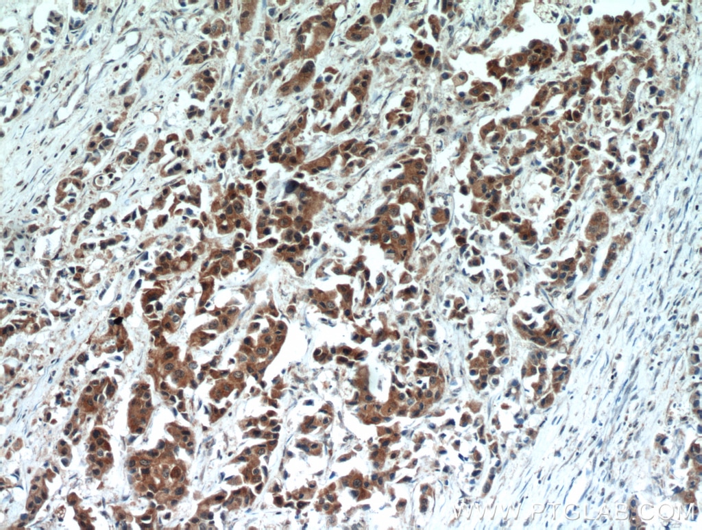 Immunohistochemistry (IHC) staining of human breast cancer tissue using HSPA1L Polyclonal antibody (13970-1-AP)
