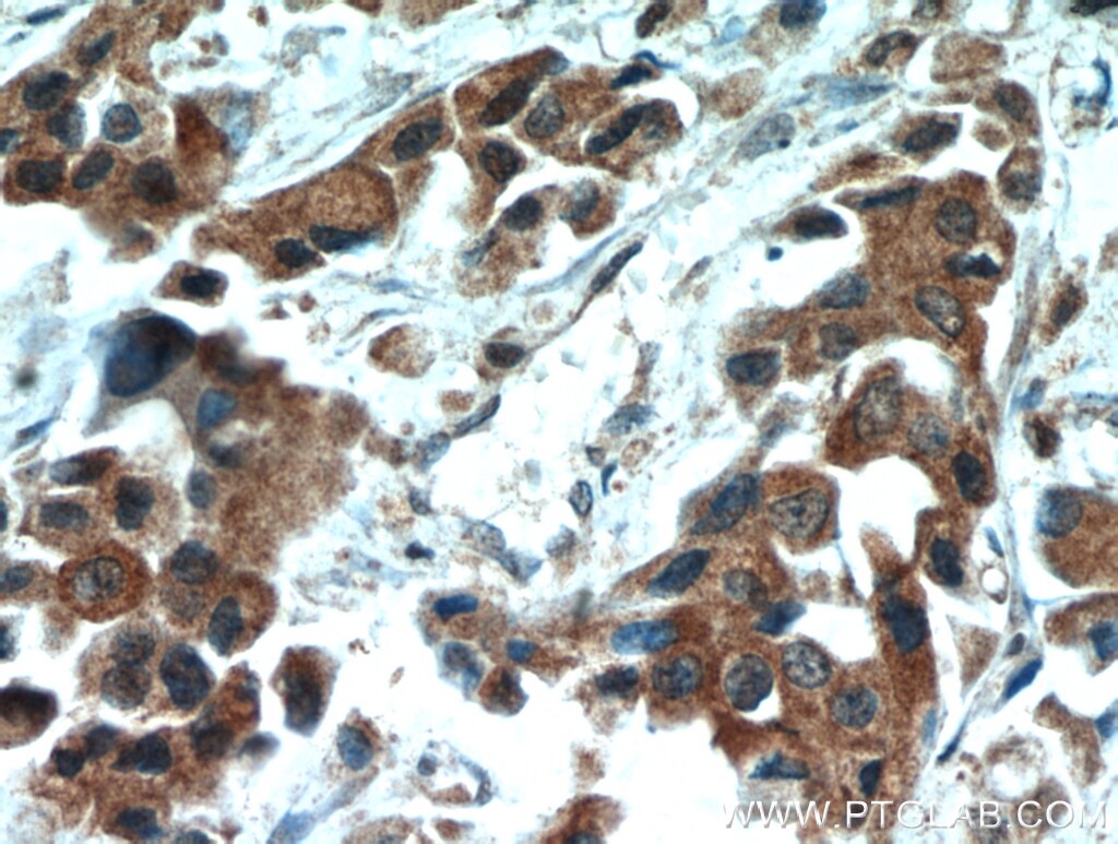 Immunohistochemistry (IHC) staining of human breast cancer tissue using HSPA1L Polyclonal antibody (13970-1-AP)