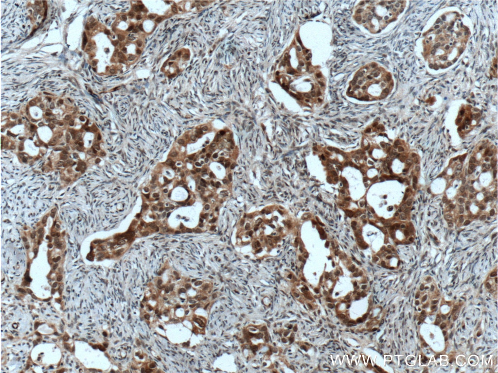 Immunohistochemistry (IHC) staining of human ovary tumor tissue using HSPA2 Polyclonal antibody (12797-1-AP)