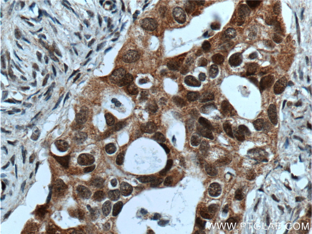 Immunohistochemistry (IHC) staining of human ovary tumor tissue using HSPA2 Polyclonal antibody (12797-1-AP)