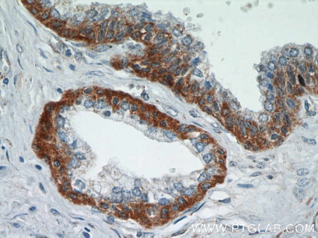 IHC staining of human prostate hyperplasia using 12797-1-AP