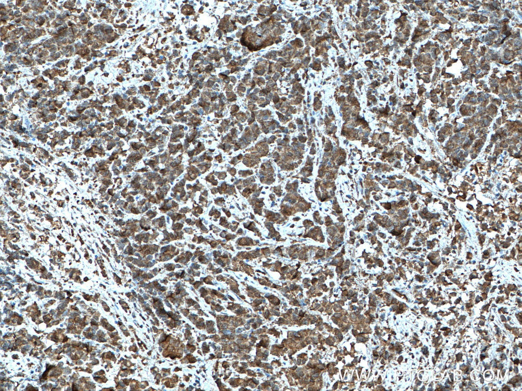 Immunohistochemistry (IHC) staining of human prostate cancer tissue using HSPA2 Monoclonal antibody (66291-1-Ig)