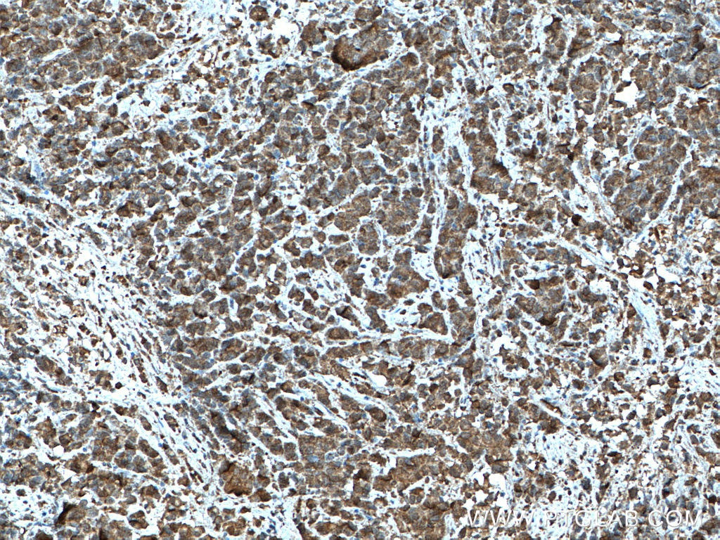 IHC staining of human prostate cancer using 66291-1-Ig